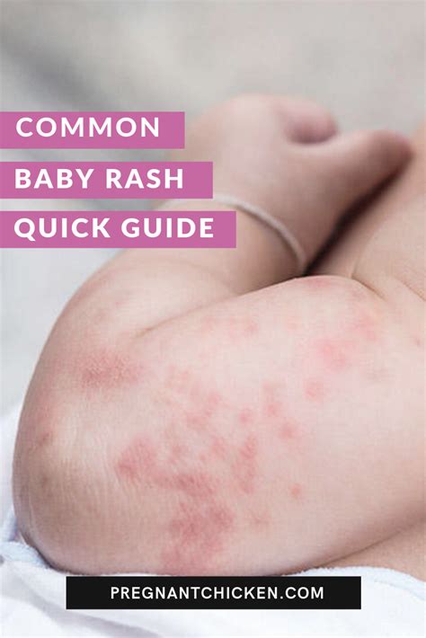 Fungal Diaper Rash Types - Design Talk