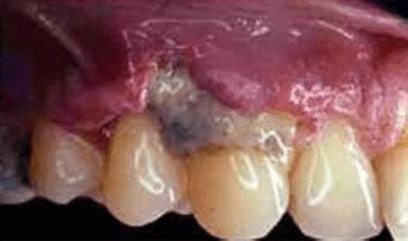 Gum Graft Failure Symptoms: Signs You Shouldn't Ignore (pictures)