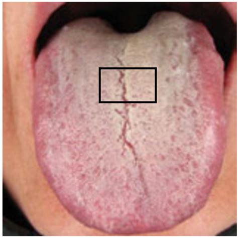 PCA and PLS-DA analysis of the metabolic profiles of tongue coating ...