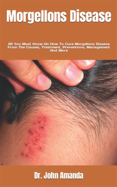 Morgellons Disease: All You Must Know On How To Cure Morgellons Disease ...