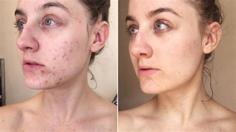 Her before and after pictures are everything. Pimple Causes, Acne And ...