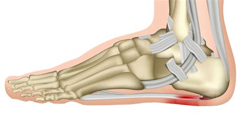 Plantar Fasciitis - Symptoms, Causes, Treatment & Exercises