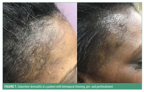 seborrheic dermatitis hair loss permanent - Had A Fat Podcast Photography