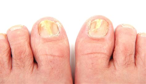 Photos of toenail fungus - Awesome Nail