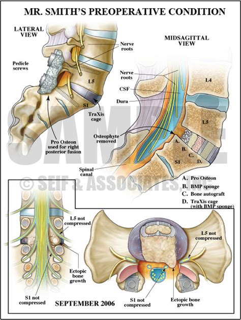 Lumbar Nerve Root Case Study - S&A Medical Graphics