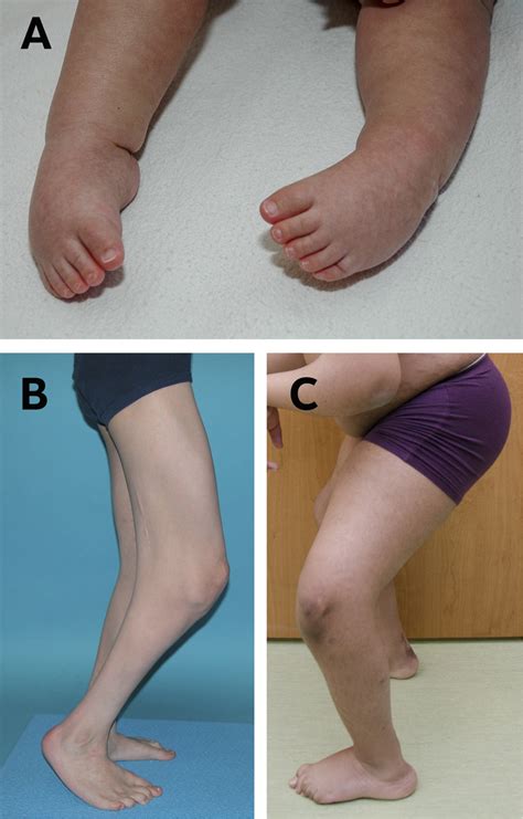 Flexion Contracture