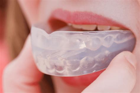 Mouth Guards For Bruxism - Burwood Dental Care