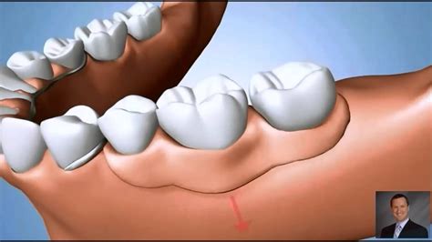 Partial Denture Problems | Implant Dentist Pasadena TX - YouTube