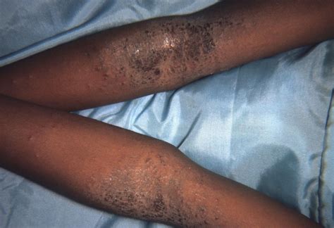 Atopic Eczema On Black Skin