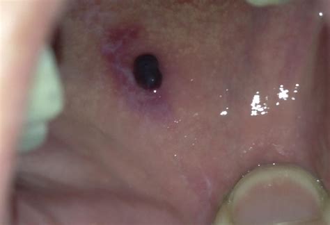 Blood blister in mouth: Pictures and treatment - Dental Implants Chula Vista