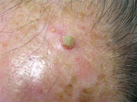 Actinic Keratosis Pictures