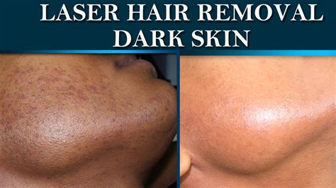 Laser hair removal at Dermalogics. Before & After on dark skin. - YouTube