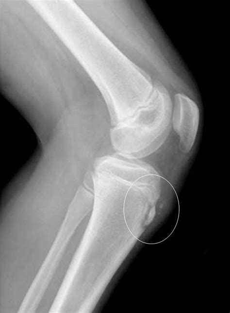 FIGURE 5: Tibial tubercle avulsion fracture | PEMXRAYS | Flickr