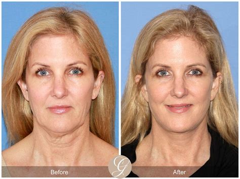 Facelift Fifties Before & After Photos Patient 49 | Dr Kevin Sadati