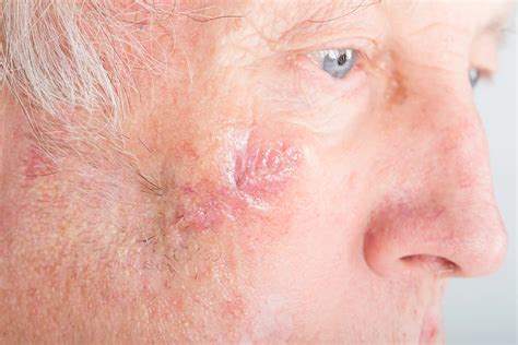 Is Mohs Surgery the Best Option for Treating Atypical Fibroxanthoma? | Dermatology and Skin ...