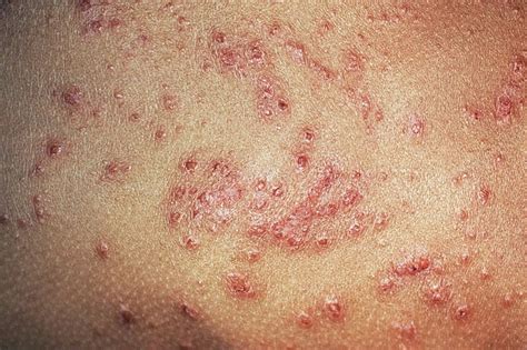 Characterizing Staphylococcus Aureus Colonization During Eczema Disease Flares - Dermatology Advisor