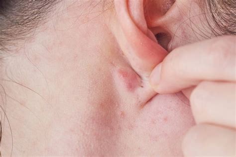 Swollen Lymph Nodes Behind Ear Serious - Infoupdate.org