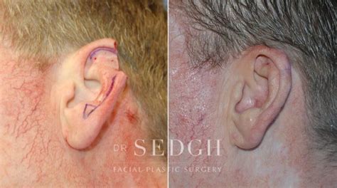 Mohs Surgery Before & After Photos | Dr. Sedgh