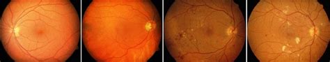 Normal and DR images. (From left to right: normal; mild NPDR; moderate... | Download Scientific ...