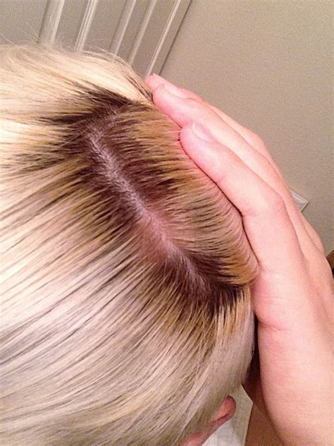 #hairbirthmark hair birthmark #mallenmark mallen mark #platinumblonde ...