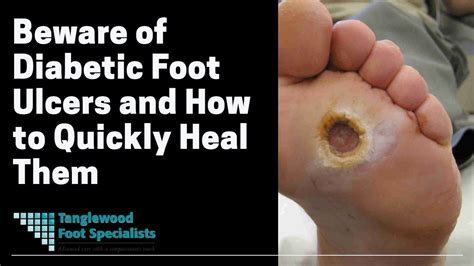 Beware of Diabetic Foot Ulcers and How to Quickly Heal Them - YouTube