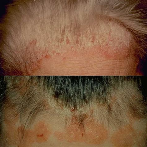 Natural Scalp Psoriasis Treatment With Tea Tree Oil and Olive Oil ...