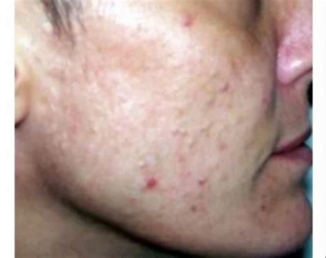 Chicken Pox Scars at best price in Ludhiana | ID: 17836157112