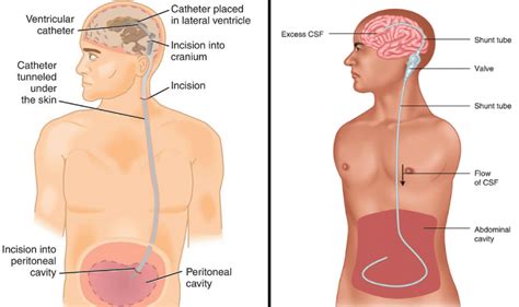 VP Shunt Surgery in India: Types, Procedure, and Top Hospitals | Vaidam Health