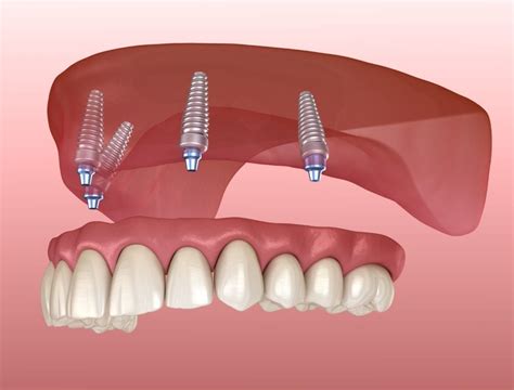 removable dental prosthesis types | CARDS DENTAL