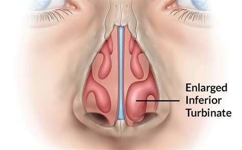 Turbinate Hypertrophy | SINUS INSTITUTE