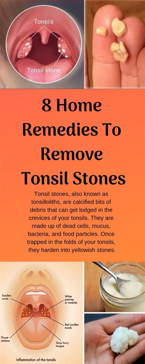 How To Get Rid Of White Spots On Tonsils Causes Home Remedies Home ...