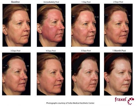 Laser Resurfacing in Philadelphia | About Face Aesthetics | Laser skin resurfacing, Skin ...