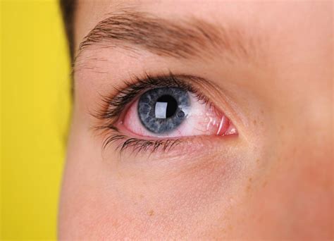 Dealing with a Scratched Eye | Dittman Eyecare