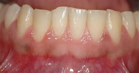 Periodontia - Mais Sobre a Especialidade e Doenças Comuns