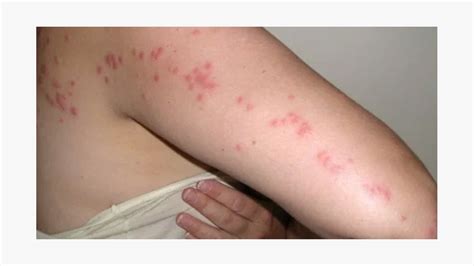 Smart Info About How To Diagnose Bed Bug Bites - Spellquestion