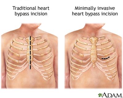 Heart bypass surgery incision: MedlinePlus Medical Encyclopedia Image