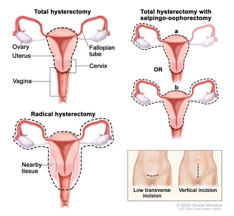 unilateral salpingo-oophorectomy (Patient) - Siteman Cancer Center