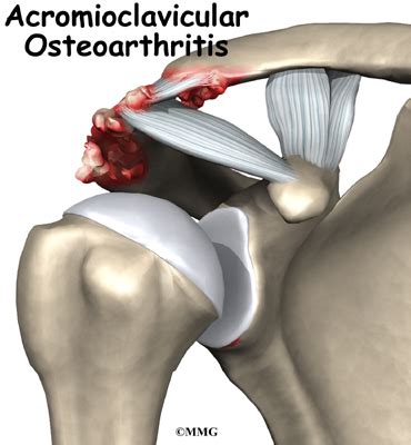 Osteoarthritis of the Acromioclavicular Joint - eOrthopod.com