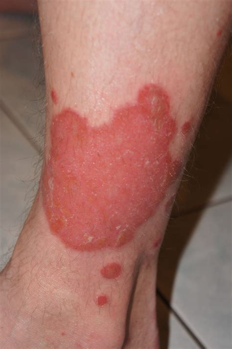 Treatment Options for Different Types of Psoriasis - The Dermatology Clinic