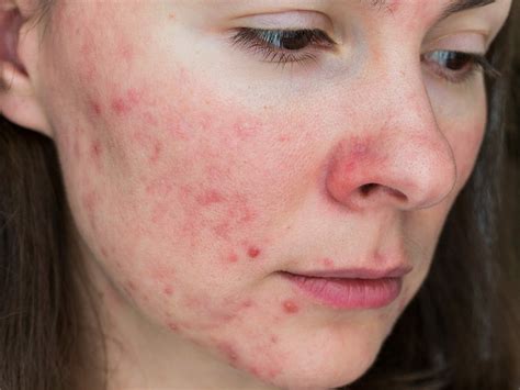 Demodex Mites With T-Cell Exhaustion in Rosacea Patients With Papulopustules - Dermatology Advisor