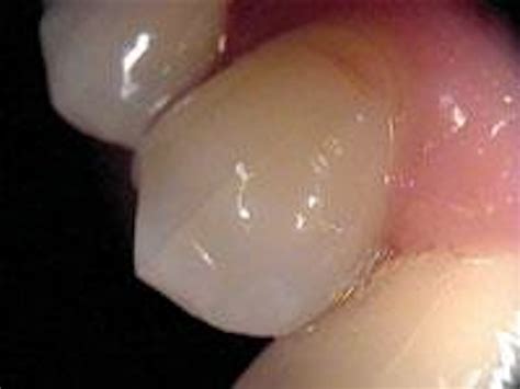 Cracked tooth syndrome | DentistryIQ