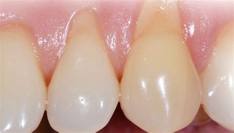 ¿Qué es la abrasión dental? Causas y tratamiento - CCM Dental