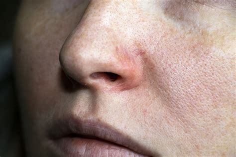 Rhinophyma: Everything about rosacea only on the nose