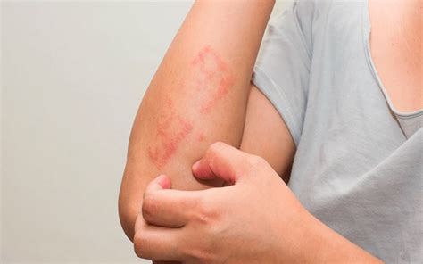 10 remedios caseros fáciles para el eczema (dermatitis atópica)