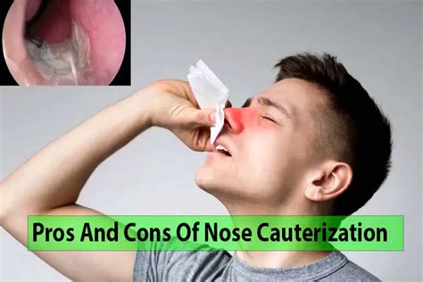 8 Key Pros And Cons Of Nose Cauterization - Healthy Anozo