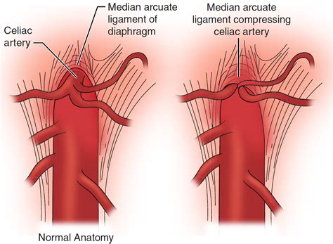 Why You Should Know About Celiac Artery Compression, 41% OFF