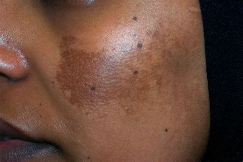 Melasma: Symptome, Ursachen, Diagnose und Behandlung