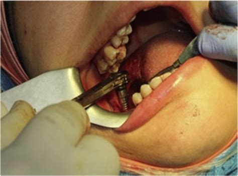 Expansion using expander. | Download Scientific Diagram