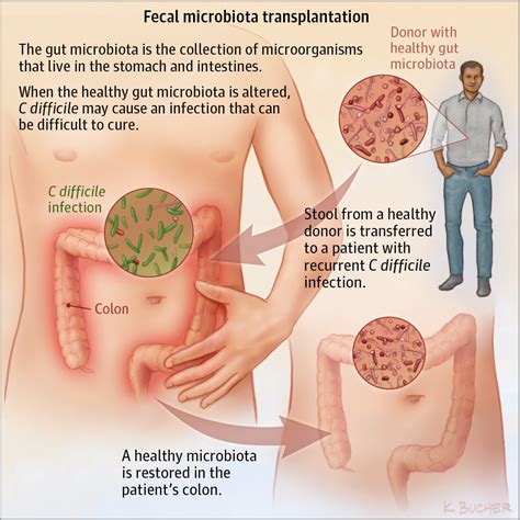 Fecal Microbiota Transplantation. | Gastroenterology | JAMA | JAMA Network