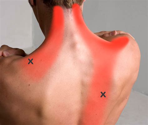 Trapezius Trigger Point Pain